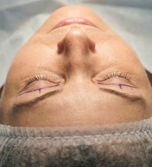 Chirurgia (Blefaroplastika)